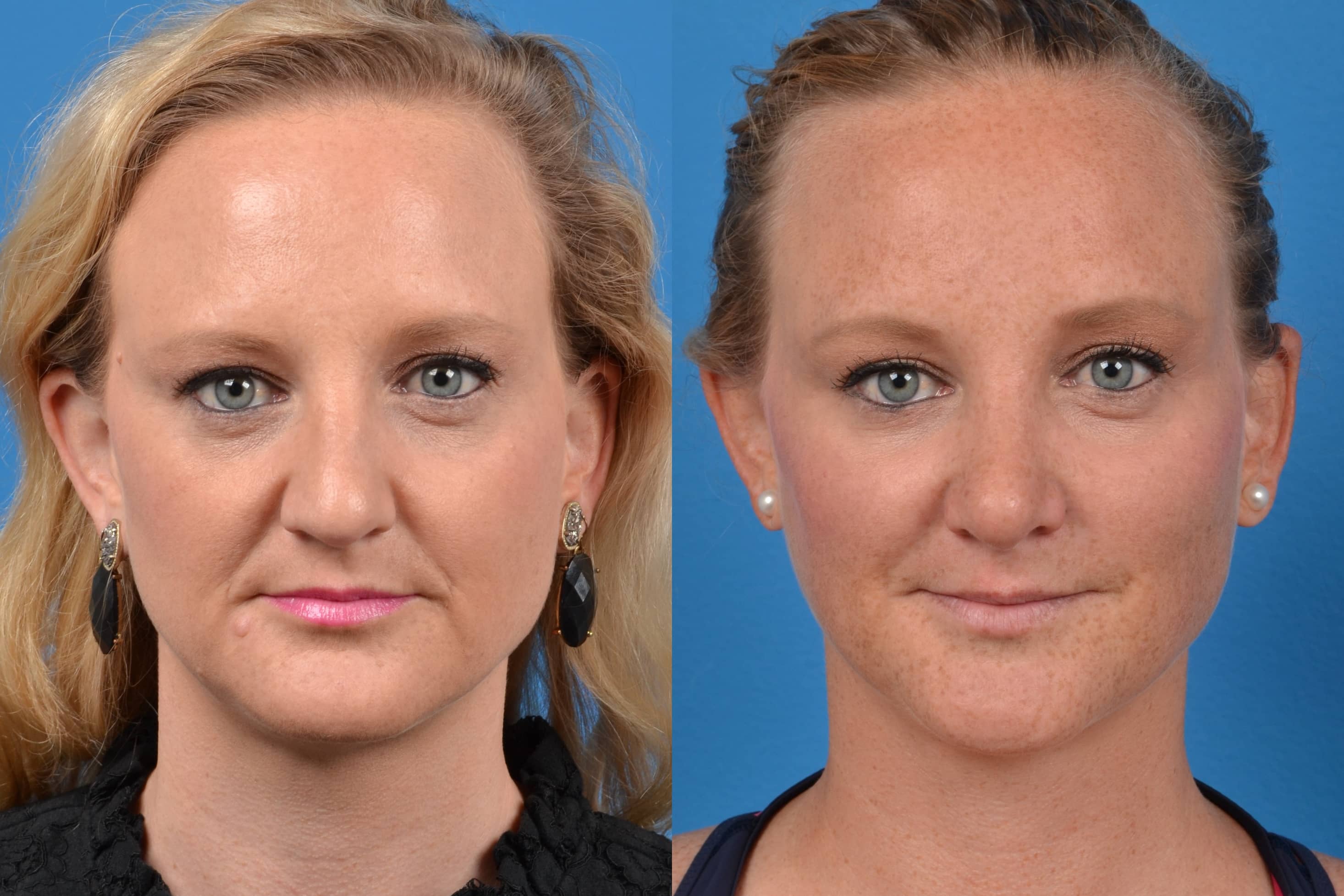 Rhinoplasty Photos Melbourne, FL Patient 29483
